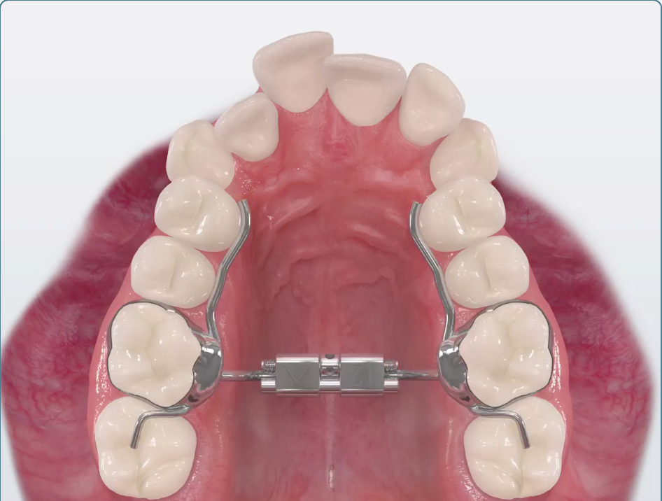 Lower Jaw Expander
